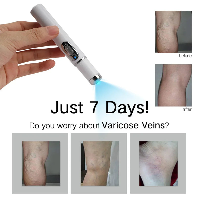 Varicose Vein Reducer and Remover 