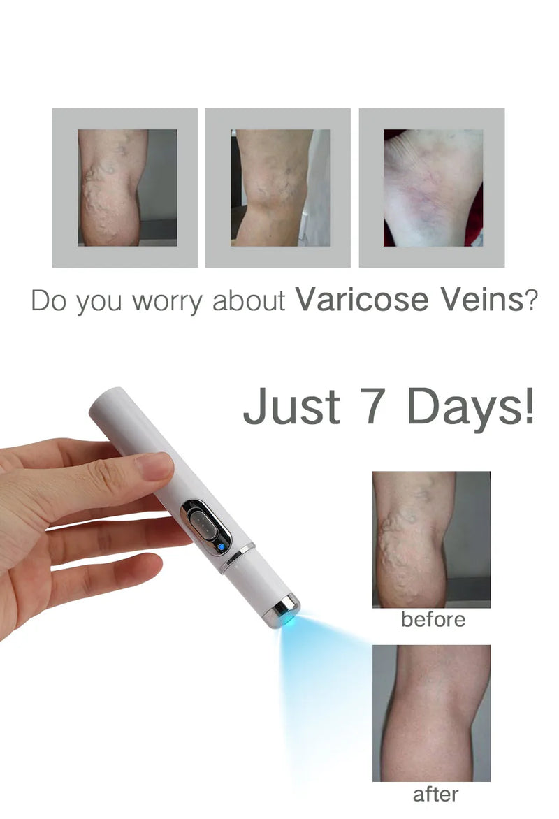 Varicose Vein Reducer and Remover 